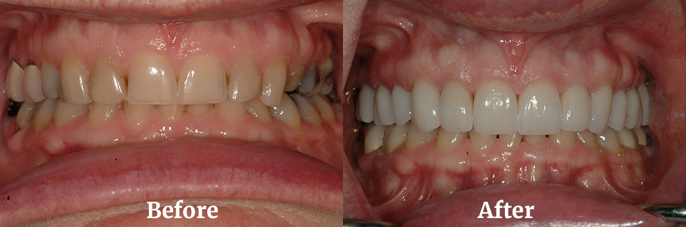 Full Maxillary Arch Reconstruction