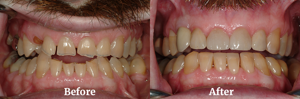 Full Maxillary Arch Reconstruction