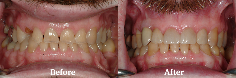 Full Maxillary Arch Reconstruction