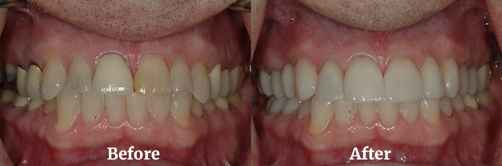 Full Maxillary Arch Reconstruction