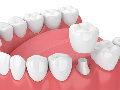 Illustration of a Dental Crown Being Placed