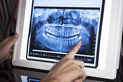 Dental X-Ray on a Screen