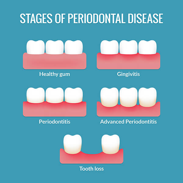 Chart Showing Gum Disease Progression