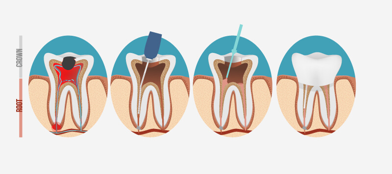 Chart Illustrating the Root Canal Process