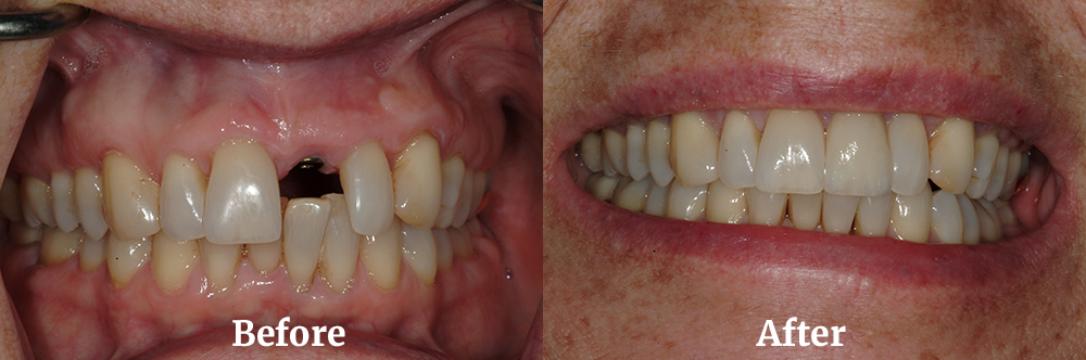 Single Tooth Implant