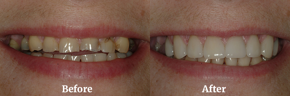 Veneers Before and After