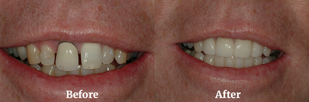 Veneers Before and After