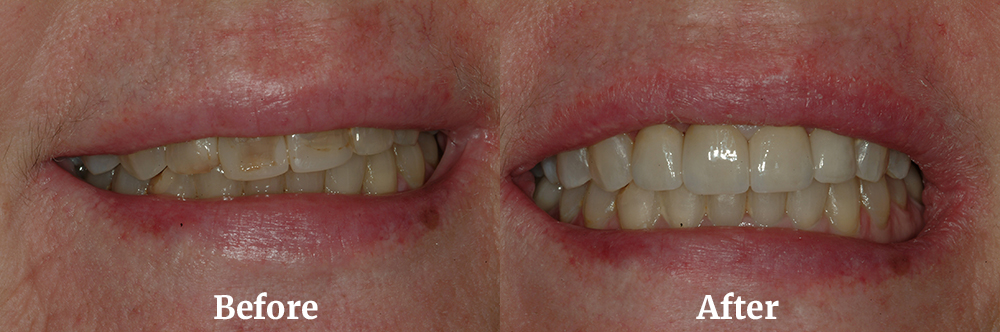 Veneers Before and After