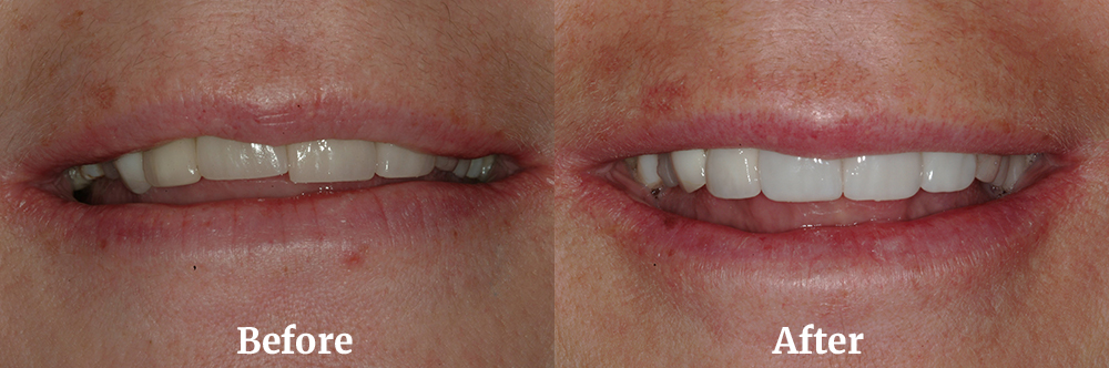 Veneers Before and After