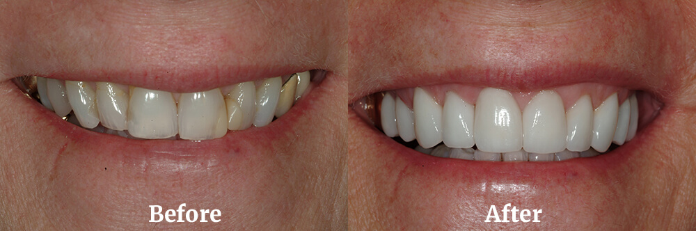 Veneers Before and After